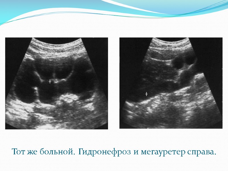 Тот же больной. Гидронефроз и мегауретер справа.